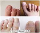 足のにごり爪・変色爪対策『クリアネイルショット アルファ』が販売実績日本一を獲得！